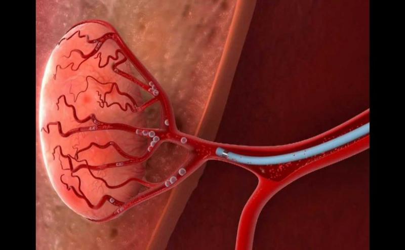 Embolization Particle Market