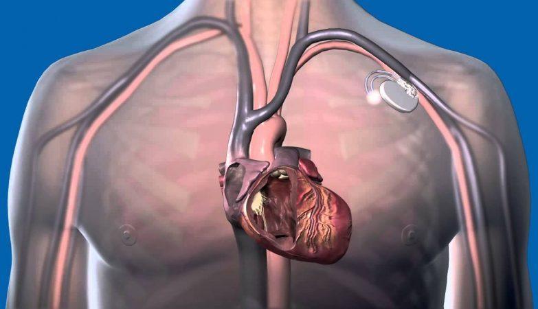 Global Active Implantable Medical Devices Market 2019, Global Active Implantable Medical Devices Market Growth ,