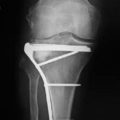Orthopedic Bone Graft Substitutes Market