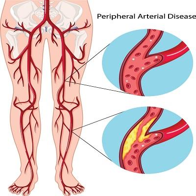 Peripheral Arterial Disease (PAD) Therapeutics Market
