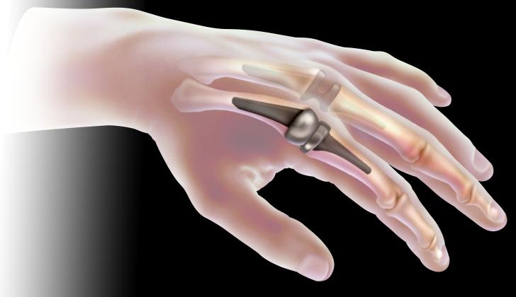 Global Joint Reconstruction Devices Market 2019, Global Joint Reconstruction Devices Market Growth,Joint Reconstruction Devices