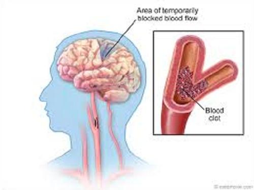 Global Transient Ischemic Attack Market 2019, Global Transient Ischemic Attack Market Growth, Transient Ischemic Attack