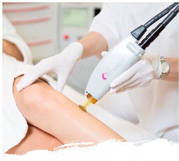 Laser hair removal on Candela Pro