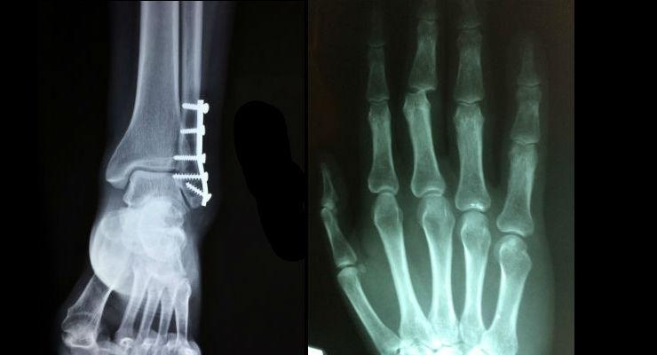 Global Orthopedic Implants Market 2019, Global Orthopedic Implants Market Growth, Global Orthopedic Implants Market Trends