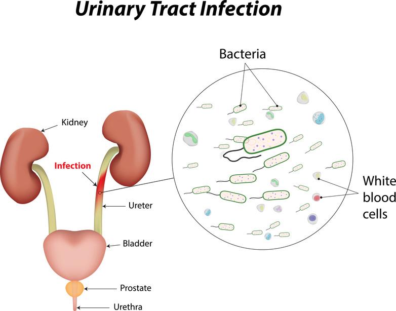 Global Urinary Tract Infection Treatment Market 2019, Global Urinary Tract Infection Treatment Market Growth,