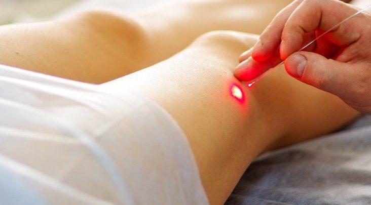 Global Varicose Vein Treatment Market 2019, Global Varicose Vein Treatment Market Growth, Global Varicose Vein Treatment Market