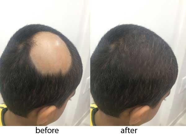 Alopecia (Hair Loss Treatment) Market