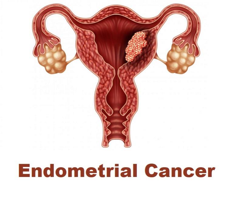 Endometrial Cancer Market