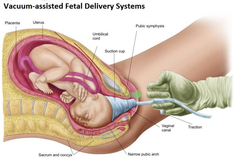 Tender Touch Vacuum Assisted Obstetric Delivery Systems