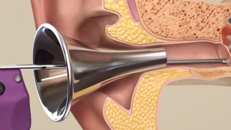 Tympanostomy Tube Systems Market: Competitive Dynamics &