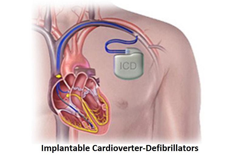 Implantable Cardioverter-Defibrillators (ICD) Market
