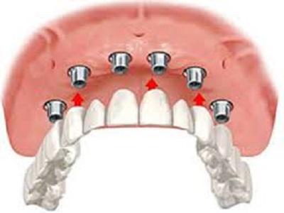 Global Dental Implant and Prosthetic Market 2020 Worldwide