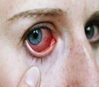 Global Uveitis Treatment Market Research Report Covers, Future Trends, Past, Present Data and Deep Analysis