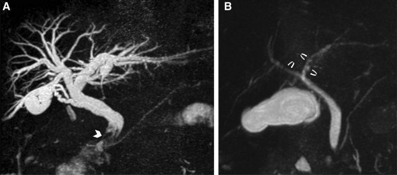 Primary Sclerosing Cholangitis Market To 2026 Anticipated