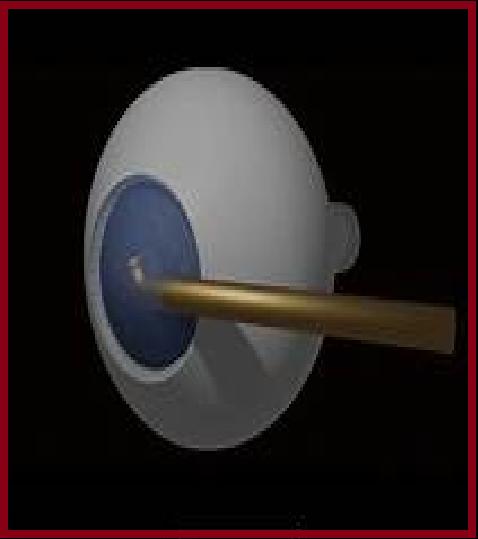 Cataract Surgery Devices Market Supply-Demand, Industry Research And End User Analysis, Outlook 2027