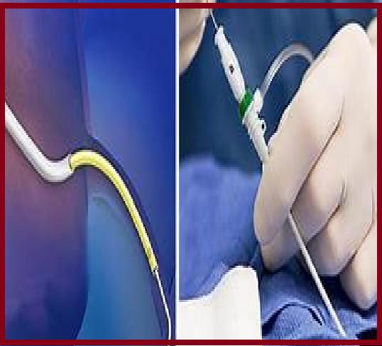 Interventional Cardiology & Peripheral Vascular Devices Market- Growth, Size, Demand, Report with In Depth Analysis -2026