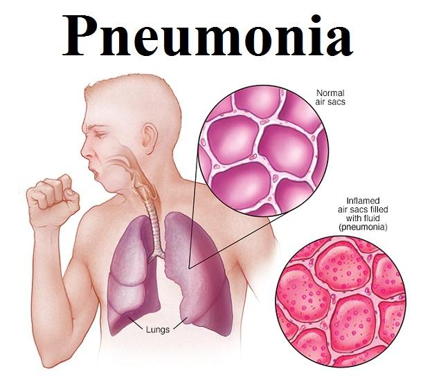 Pneumonia Market