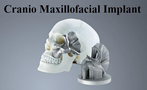 Covid-19 Impact on Cranio Maxillofacial Implant Market 2021-2025: Business Growth by Top Key Company’s - J&J, Medtronic, B Braun, Boston Medical, Integra, Stryker, Zimmer, CONMED