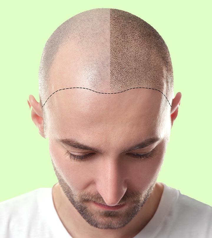 Global Hair Transplant Market Estimated 5178791 Million