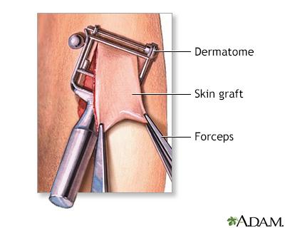 Europe Skin Graft Market