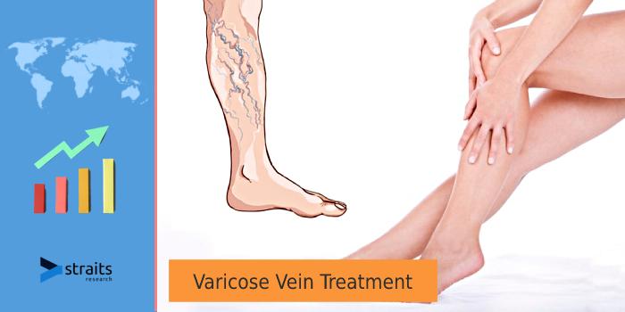 Varicose Vein Treatment Market