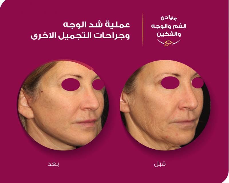 Face lifting Without Surgery By Prof. Dr. Luis Gavin