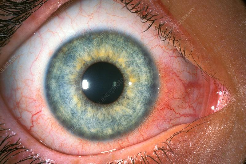 Vernal Keratonconjunctivitis Treatment Market