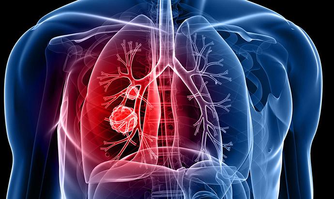 Non-Small Cell Lung Cancer Diagnostics Market