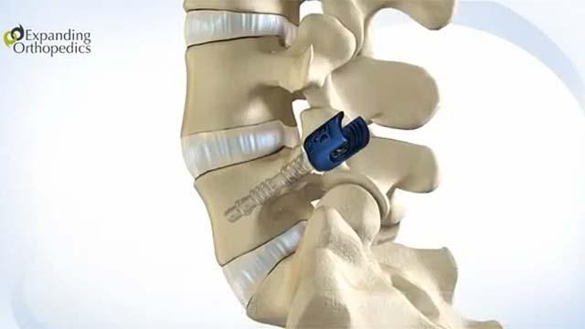 Spinal Fusion Devices Market