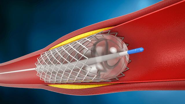 Angioplasty Balloons Market Report Up to 2031