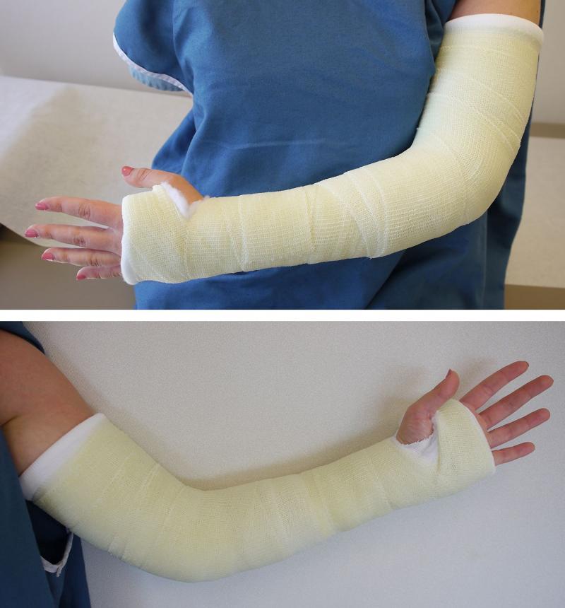 Orthopedic Splints and Casts Market