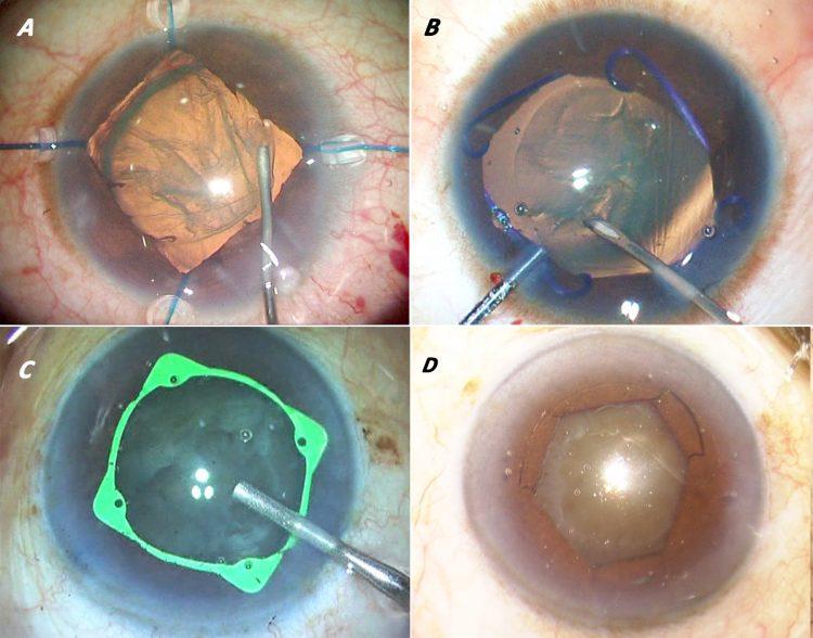 Pupil Expanders Market