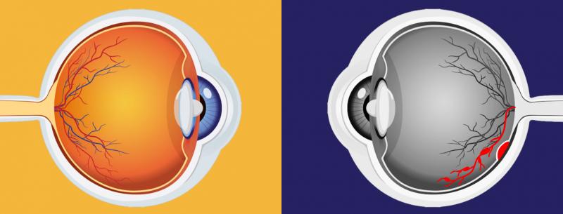 Macular Edema and Macular Degeneration Market