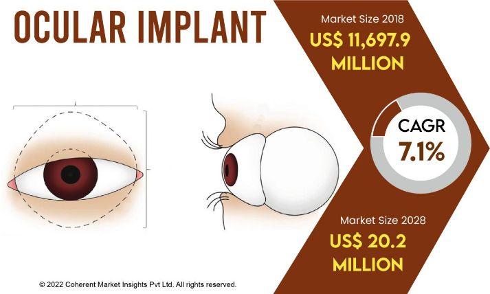 Ocular Implant Market