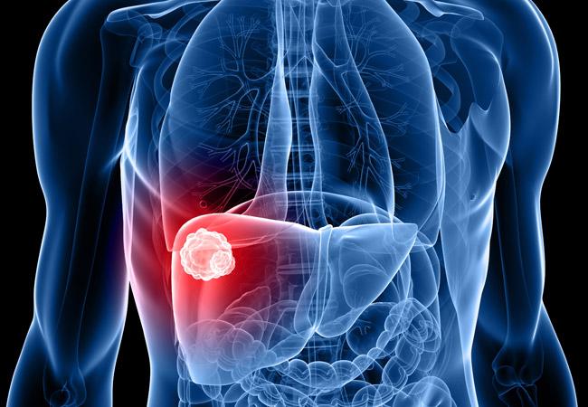 Cholangiocarcinoma Market