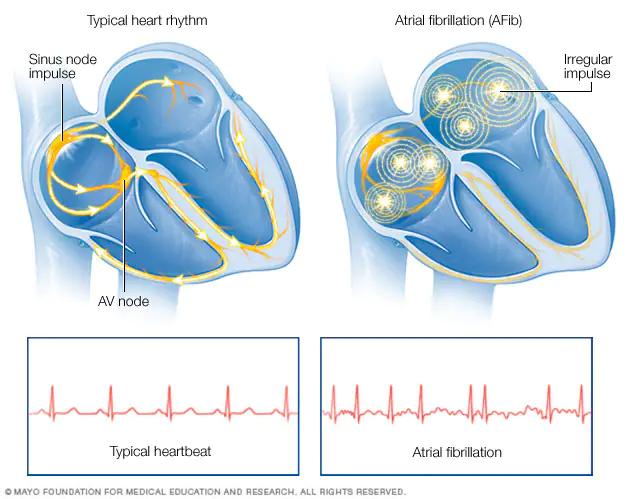 Atrial Fibrillation Market