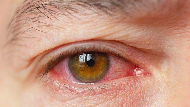 Dry Eye Syndrome Treatment Market