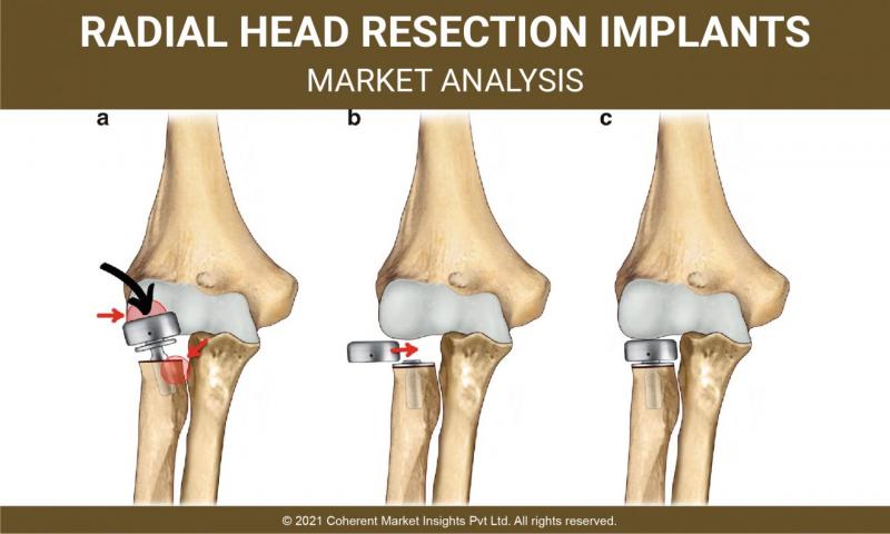 Radial Head Resection Implants Market Will Touch A New Level In Upcoming Year - Key Players Forecast 2022 - 2028 | Biomet, Inc., Wright Medical Technology, Inc, Smith & Nephew Plc