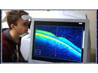 Optical Coherence Tomographer Market