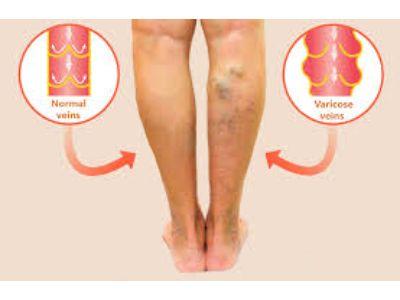 Varicose Veins Treatment Market