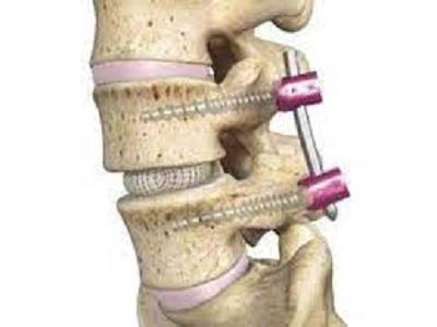 Spinal Interbody Fusion Market