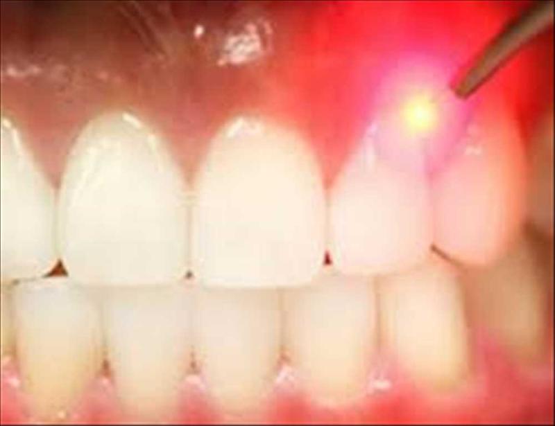 Global Dental Lasers Market