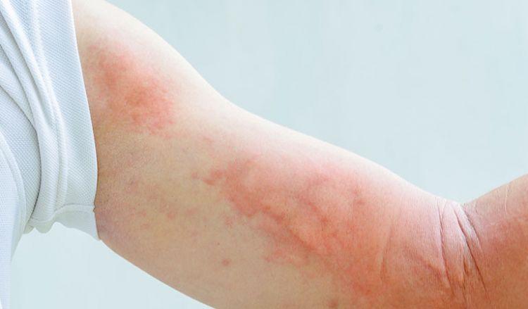 Global Chronic Urticaria Or Hives Drug Market