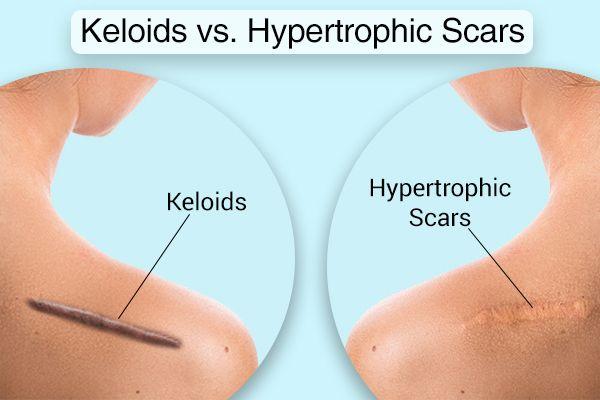 Hypertrophic and Keloid Scar Treatment Market