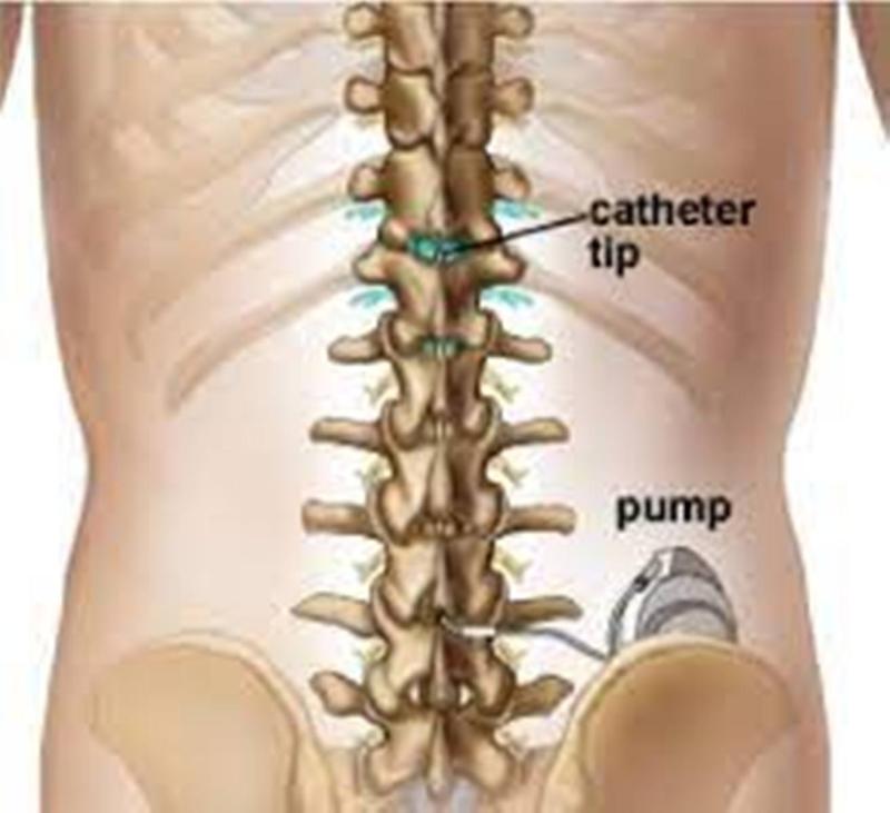 Spinal Pumps Market