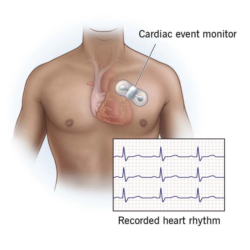 Implantable Cardiac Monitor