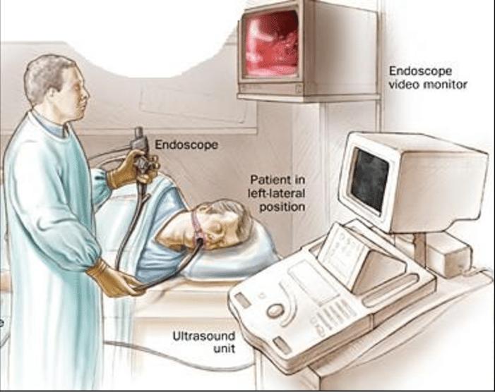 Endoscopic Retrograde Cholangiopancreatography (ERCP) Market