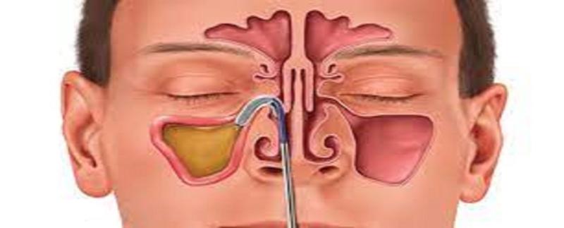 Sinus Dilation Devices Market