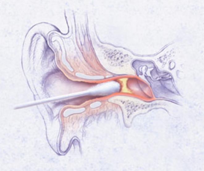 Fungal Otitis Externa Market