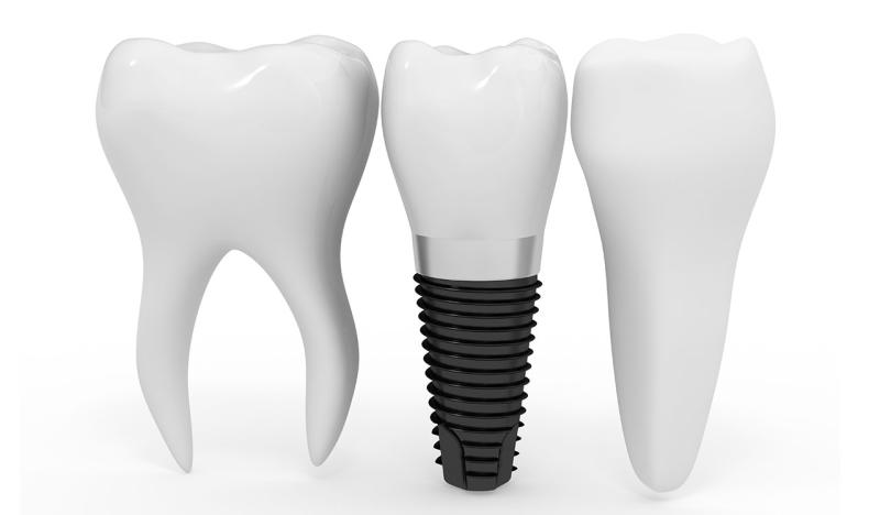 Dental Implants Industry